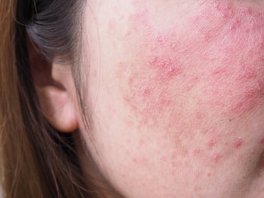 stock-photo-red-rash-on-young-asian-thai-woman-face-itchy-and-allergic-skin-problems-dermatitis_shutterstock_1953028711 web smaller