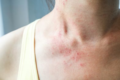 stock-photo-young-woman-has-reactive-skin-rash-itch-on-neck_shutterstock_1017422944 web mindre