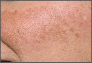 Melasma