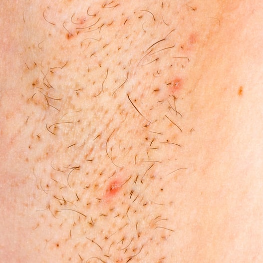 Offensive gegen eingewachsene Haare Offensive gegen eingewachsene Haare